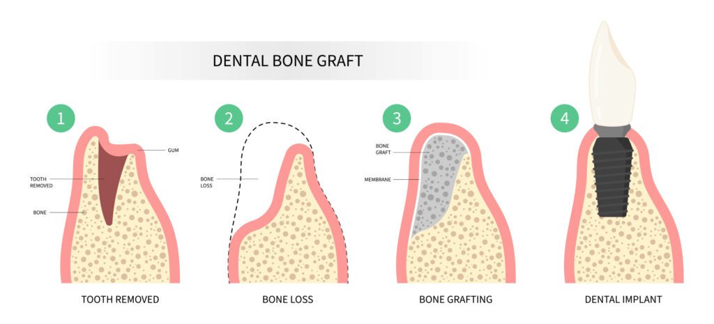 bone graft south jordan, riverton