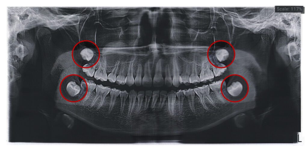wisdom teeth removal Riverton - Rocky Mountain Oral Surgery & Implant Center